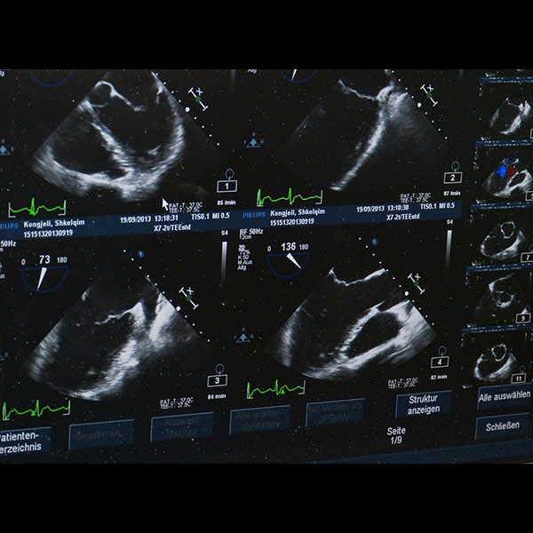 4 Boyutlu Ultrasonografi